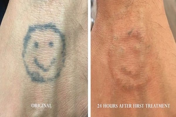 Laser removal cover-up preparation